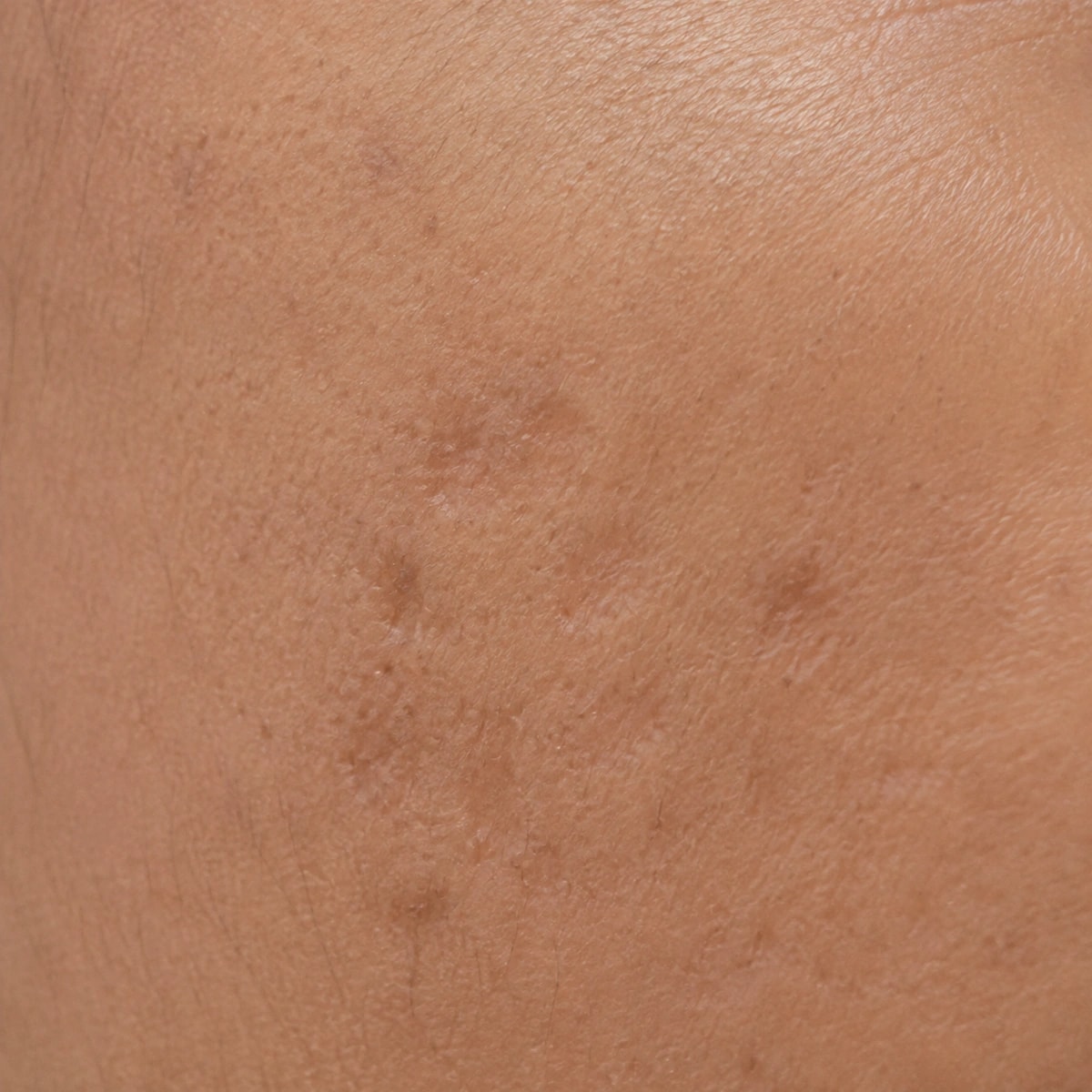 Close-up of healed acne marks and shallow skin texture