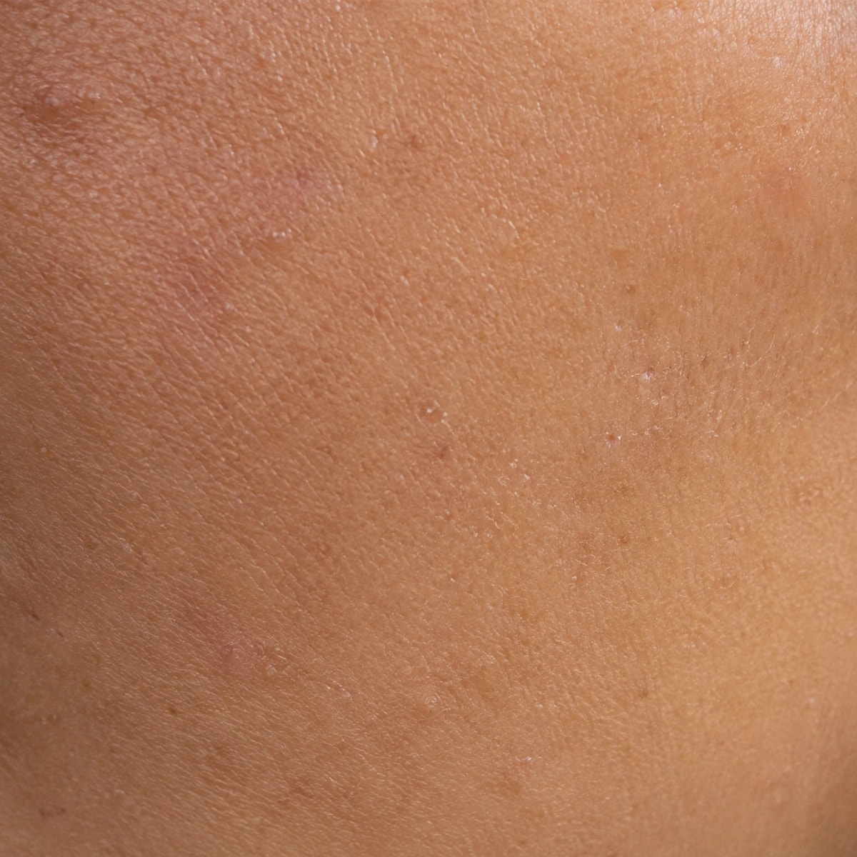 Close-up of uneven skin tone and fine surface texture