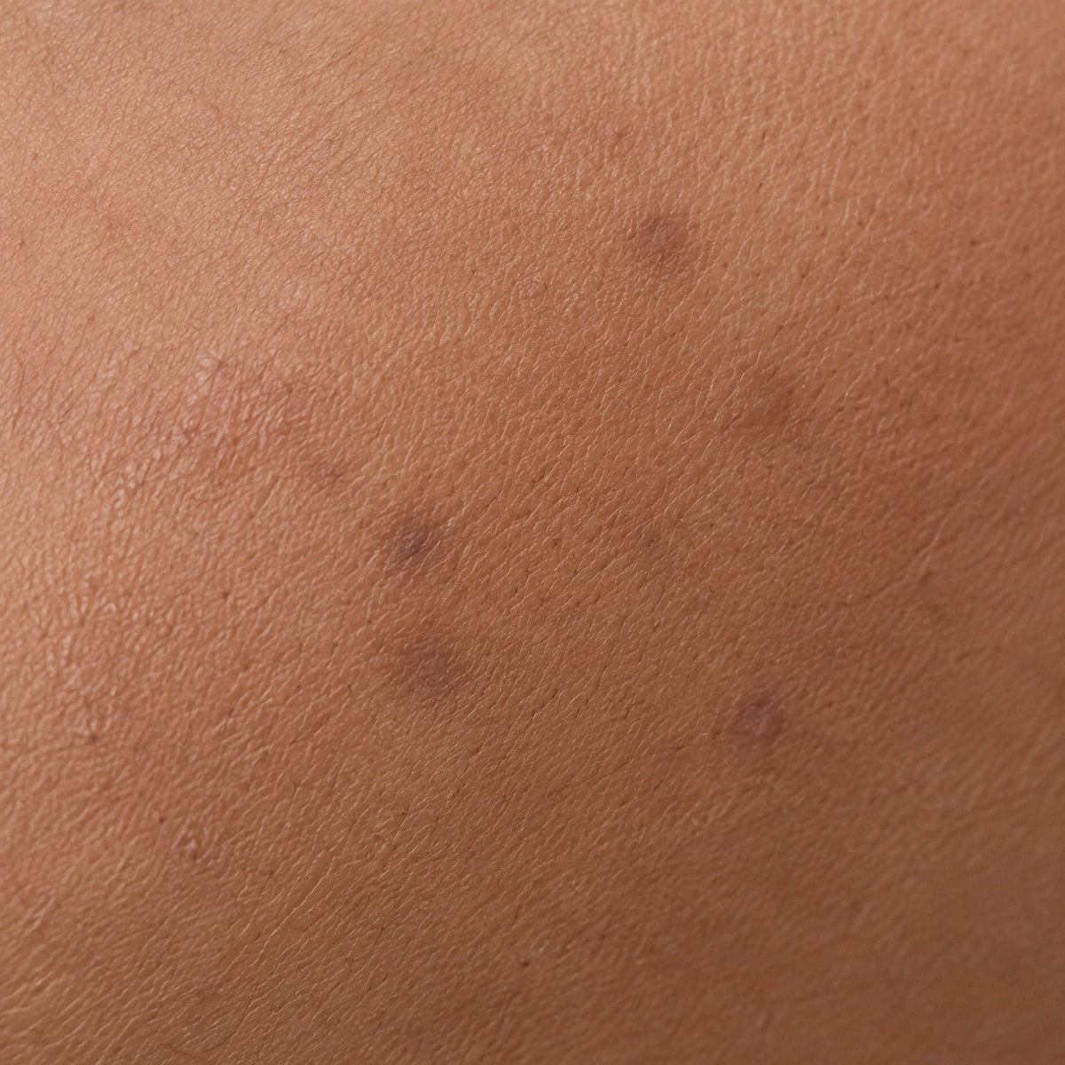Close-up of small dark marks on cheek skin