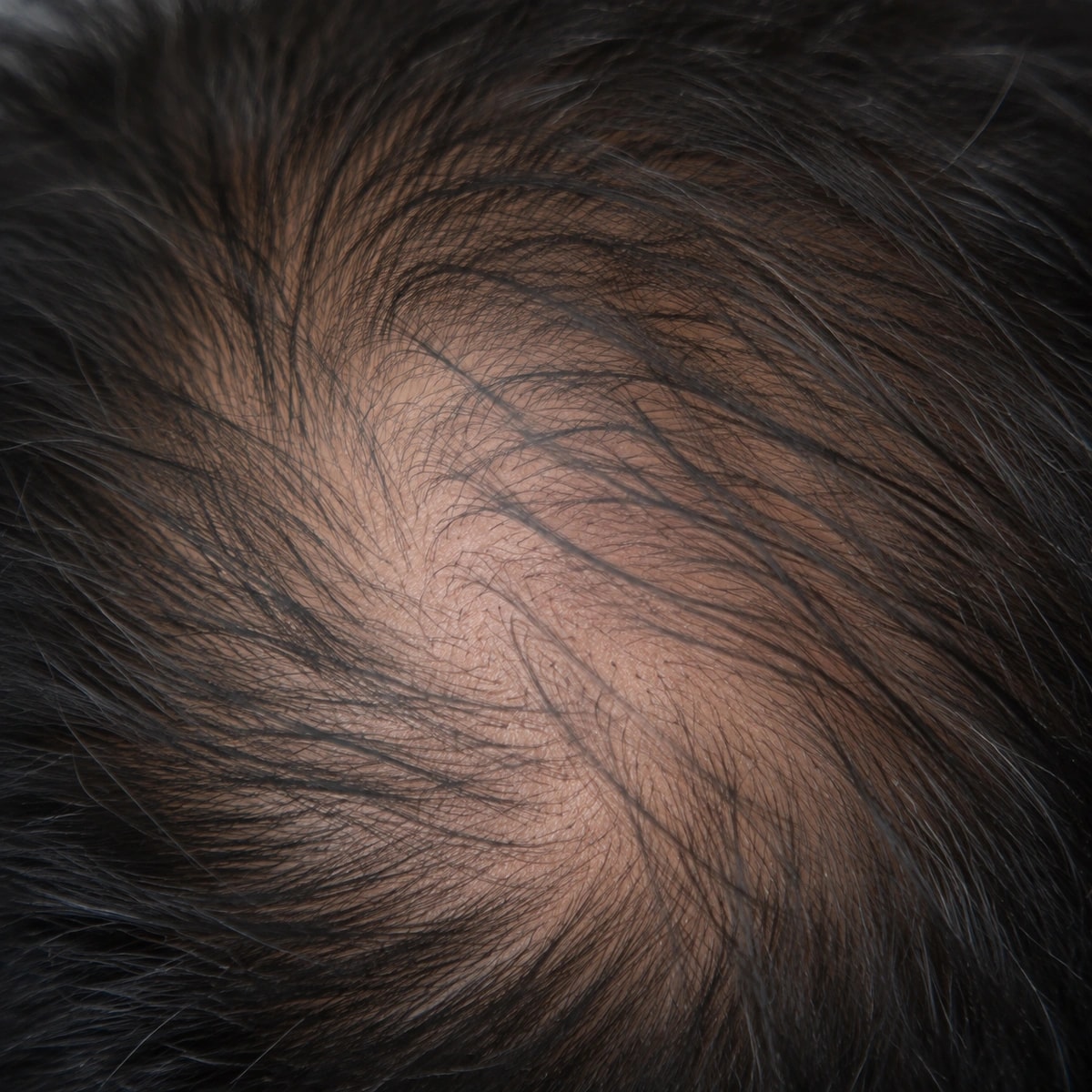 Close-up of individual hair strands and visible scalp in a thinning crown