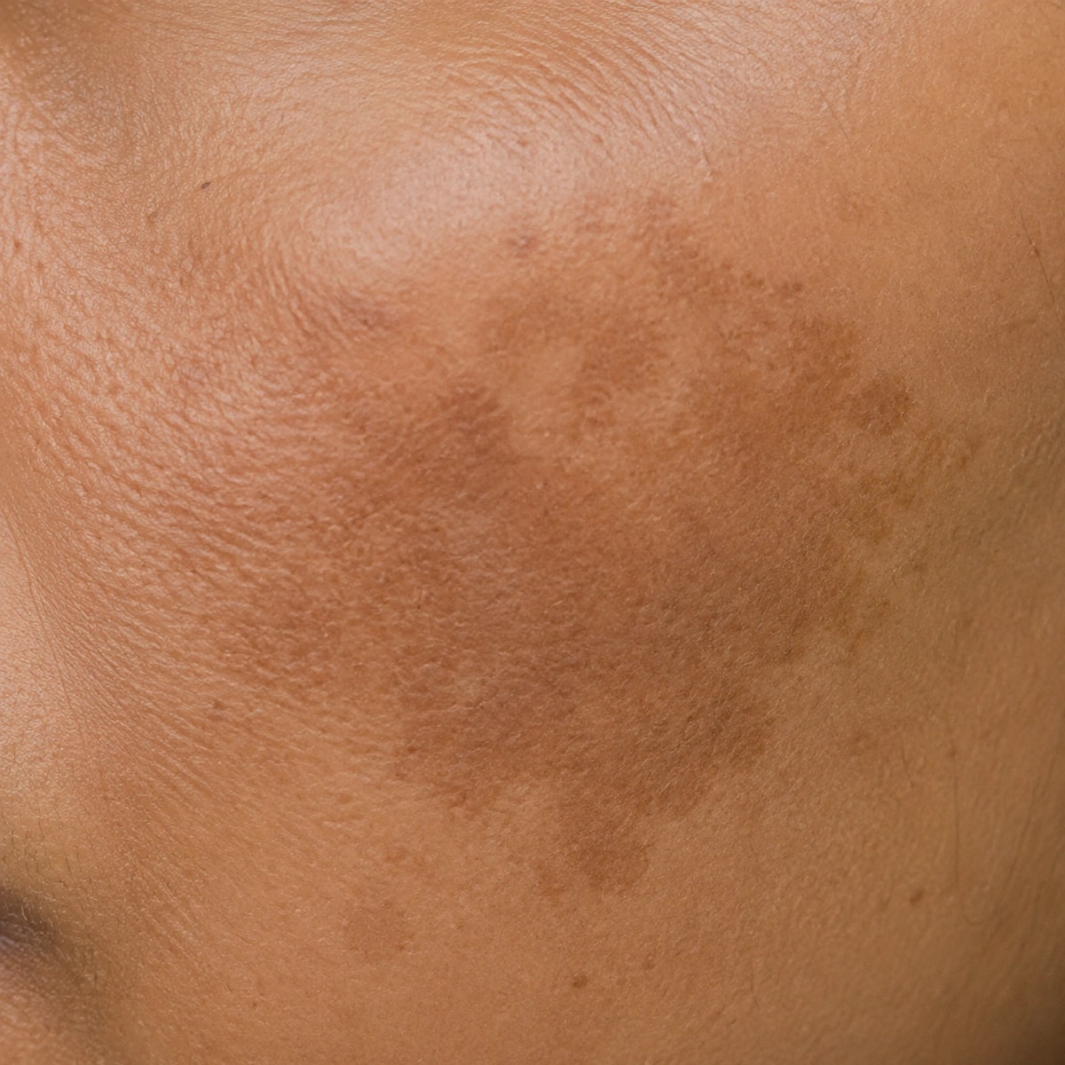 Close-up of flat brown pigmentation on cheek skin